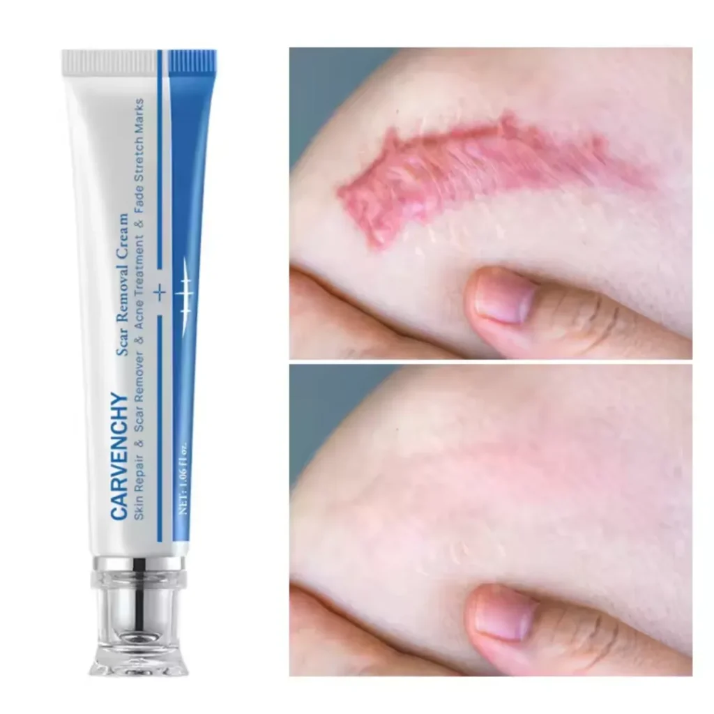 Acne scar treatment