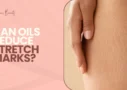 Can Oils Reduce Stretch Marks
